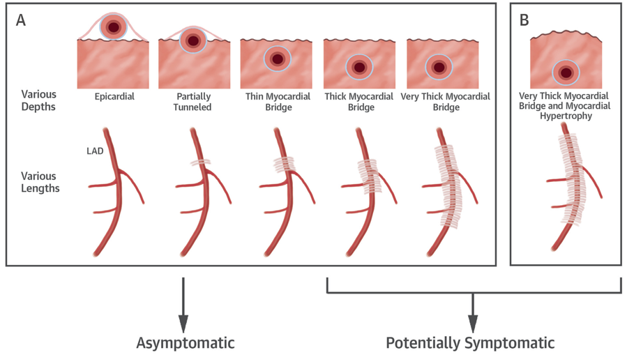 冠脉心肌桥如何发现与治疗融会冠通