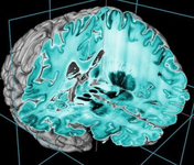 第23届欧洲卒中大会（ESC2014）