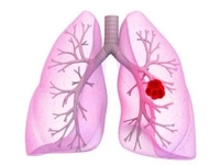 肺癌多学科治疗高峰论坛暨全军第六届肺癌规范化诊断治疗学习班