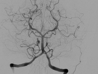 2015年国际卒中大会（ISC2015）