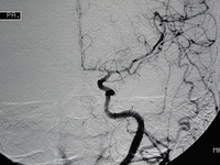 2015年国际卒中大会（ISC2015）