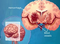 2015中国脑卒中大会