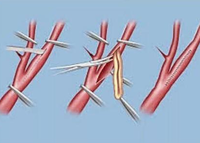 2015中国脑卒中大会