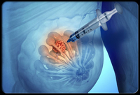 2015乳腺癌诊疗进展年度回顾