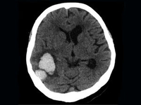 2017年国际卒中大会（ISC2017）
