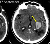 2017年国际卒中大会（ISC2017）