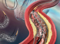 2017年美国心脏病学会年会（ACC2017）