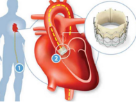 2017年美国心脏病学会年会（ACC2017）