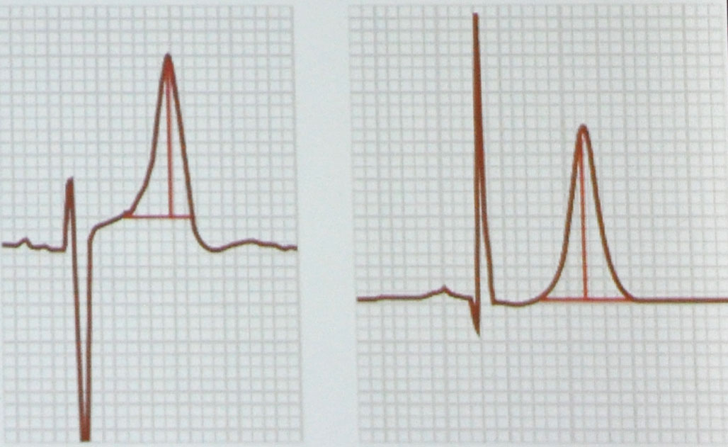 图1  左:正常t波;右超急性t波