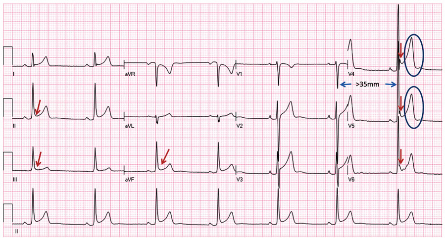 圖3 早復極心電圖