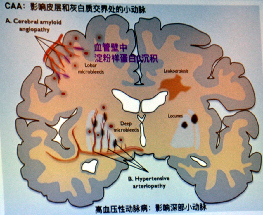 (1)高血壓性動脈病(基底節區出血):包括脂質透明變性和動脈硬化,通常