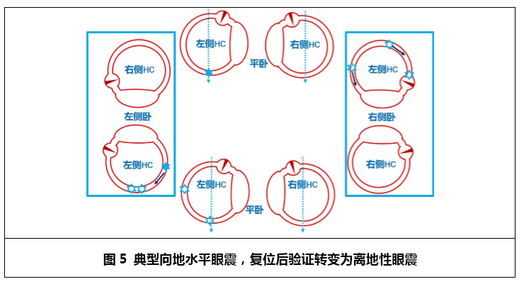 你见过这些不典型的水平半规管bppv吗?丨"晕"筹帷幄