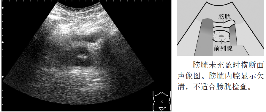 膀胱輸尿管解剖及超聲表現 | 臨床必備