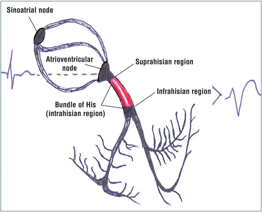 心脏传导系统示意图,可见房室之间传导包涵了房室结,希氏束,左右