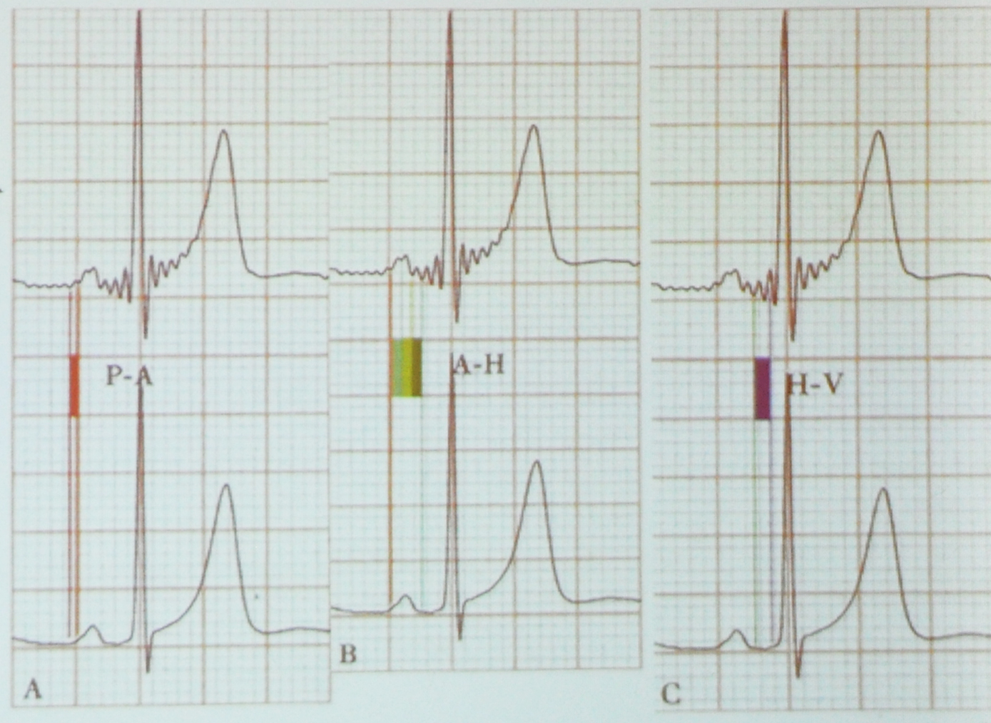 saahecg波形特征与命名:图a为pra,心房波;图b为prav,房室结波;图c
