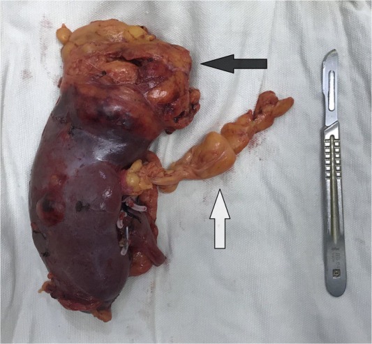 从肿瘤侵及下腔静脉出发了解肾脂肪肉瘤的诊断和治疗罕见病例