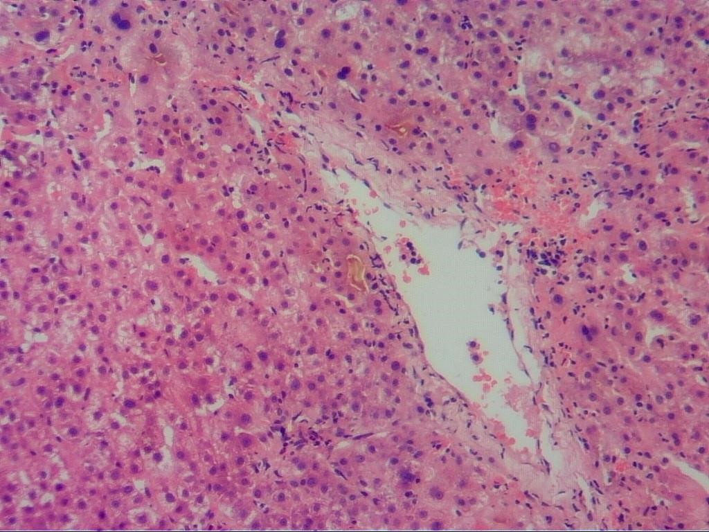 肝细胞水肿镜下图片图片
