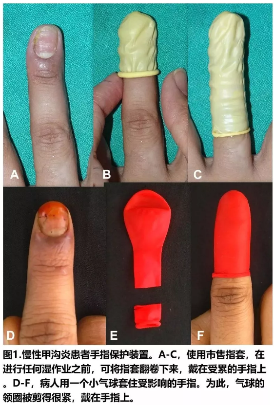 保護患皮膚病的手指:家庭主婦的居家療法_念珠菌病_慢性甲溝炎_醫脈通