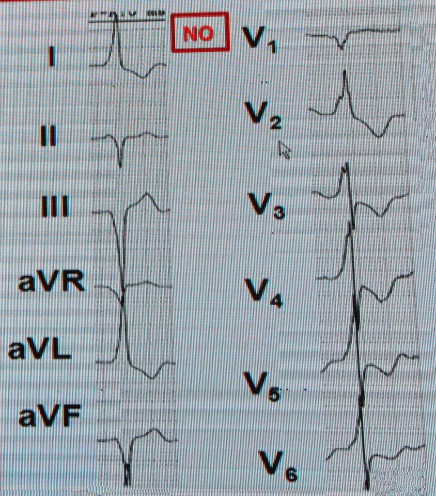 图13 病例2患者心电图
