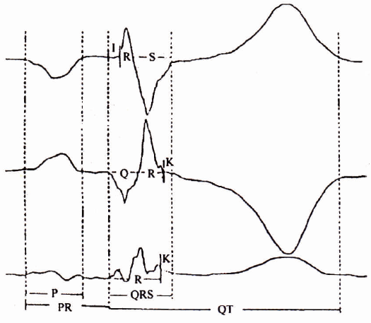 多导同步心电图p,pr,qrs,qt 时限以及特定导联q,r,s时限的测量