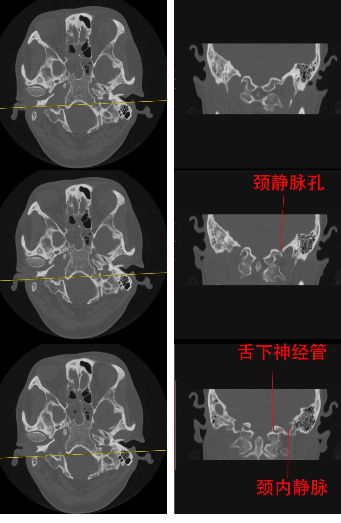 颈静脉孔综合征(vernet syndrome)是不累及舌下神经的——这也和解剖