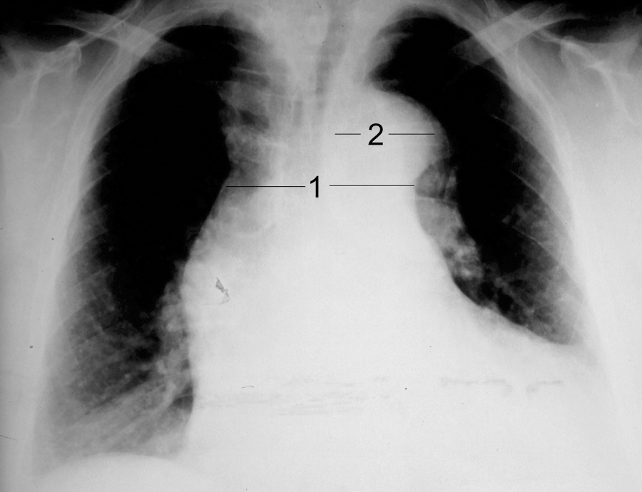 最简单的胸片可能看到表征是纵隔增宽(图3),已有主动脉破裂出血者可