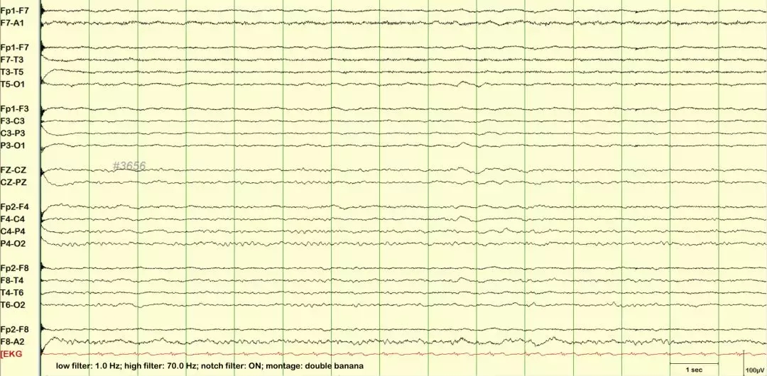 慢波异常(a) left-sided lateralized
