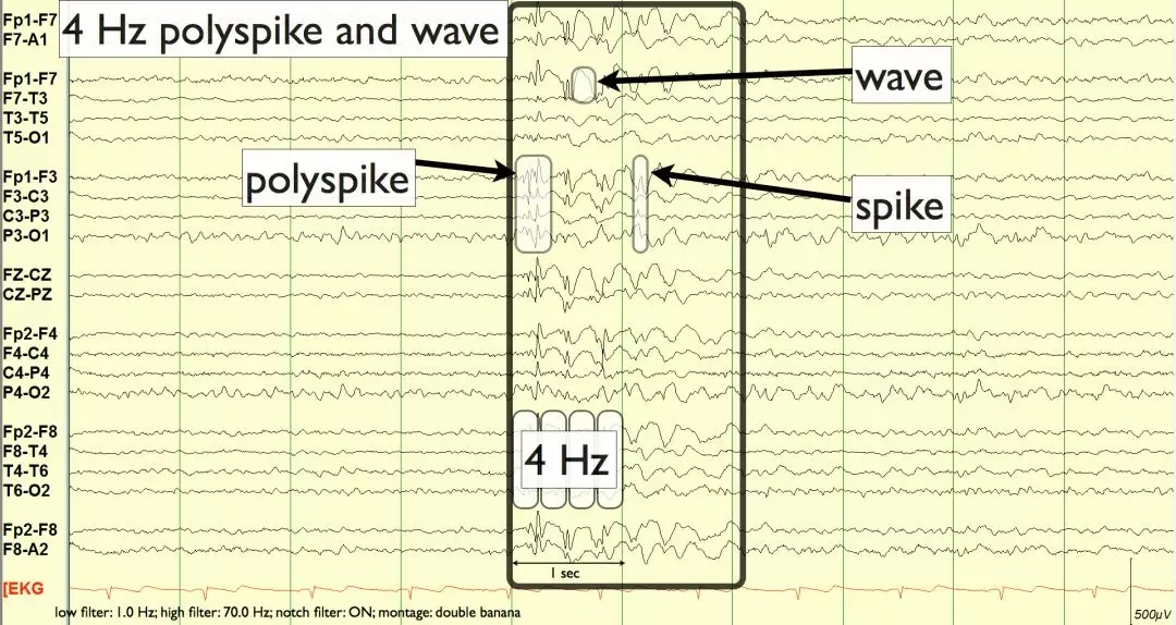 异常篇最一目了然的成人脑电图图谱丨一键收藏
