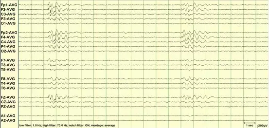 异常篇最一目了然的成人脑电图图谱丨一键收藏