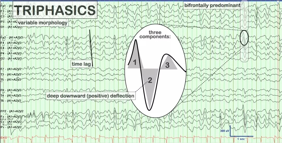 异常篇最一目了然的成人脑电图图谱丨一键收藏