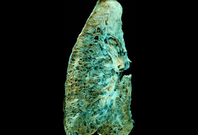肺纤维化蜂窝肺图片