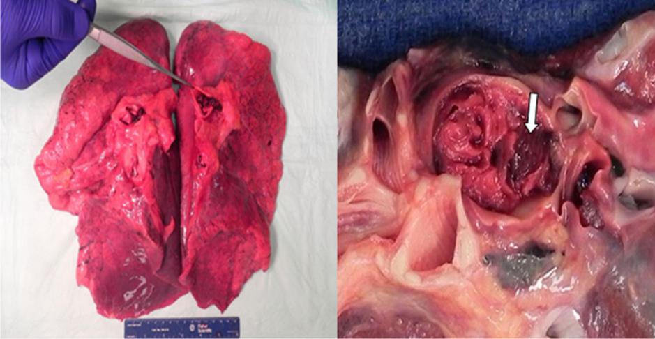 消化道出血,胸痛,st段抬高,看图猜结果丨急诊"心"事