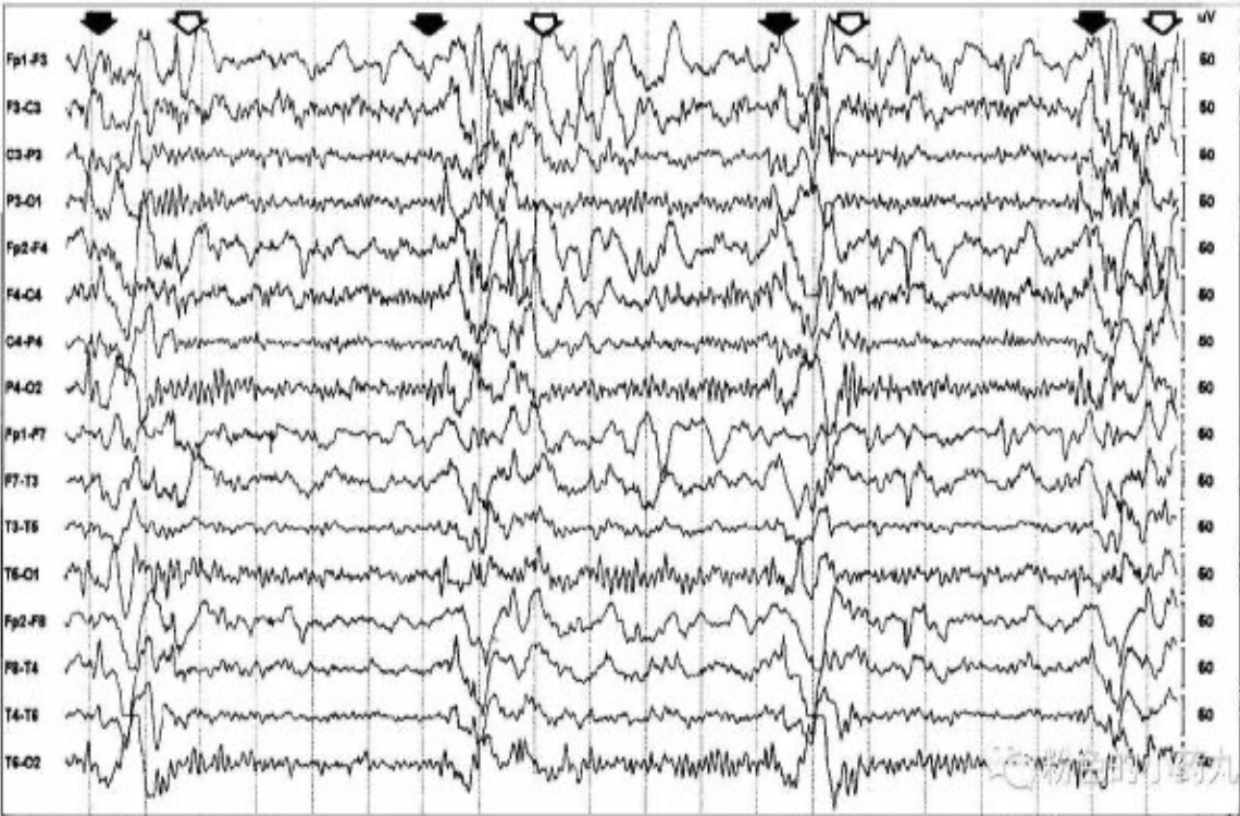 mog抗体阳性相关脱髓鞘亚历山大病亚急性硬化性全脑炎丨3分钟读片29期