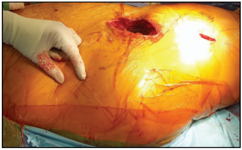 7 图示右髋手术股骨暴露过程中近端辅助切口的定位.