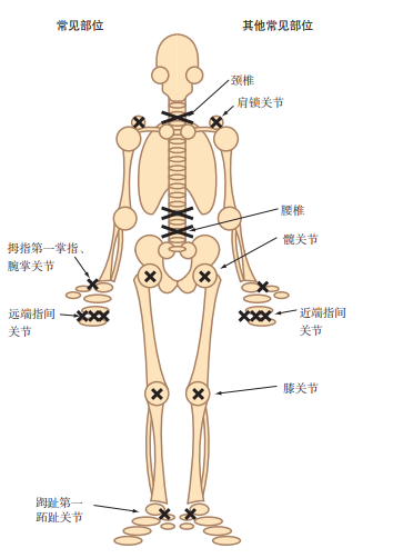 一文總結,骨性關節炎的診斷及治療|臨床實戰