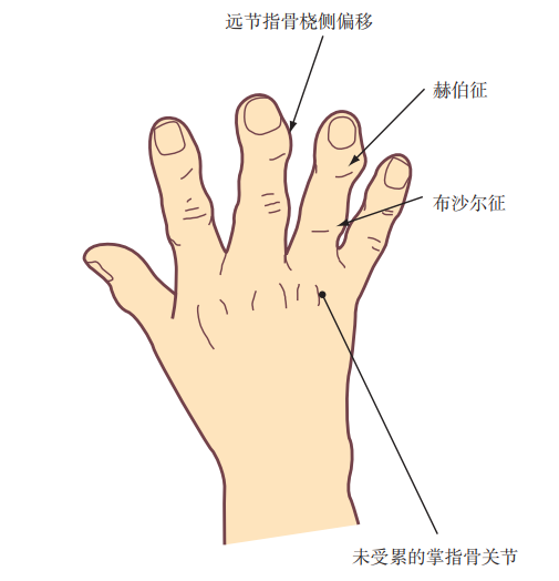 一文总结,骨性关节炎的诊断及治疗|临床实战