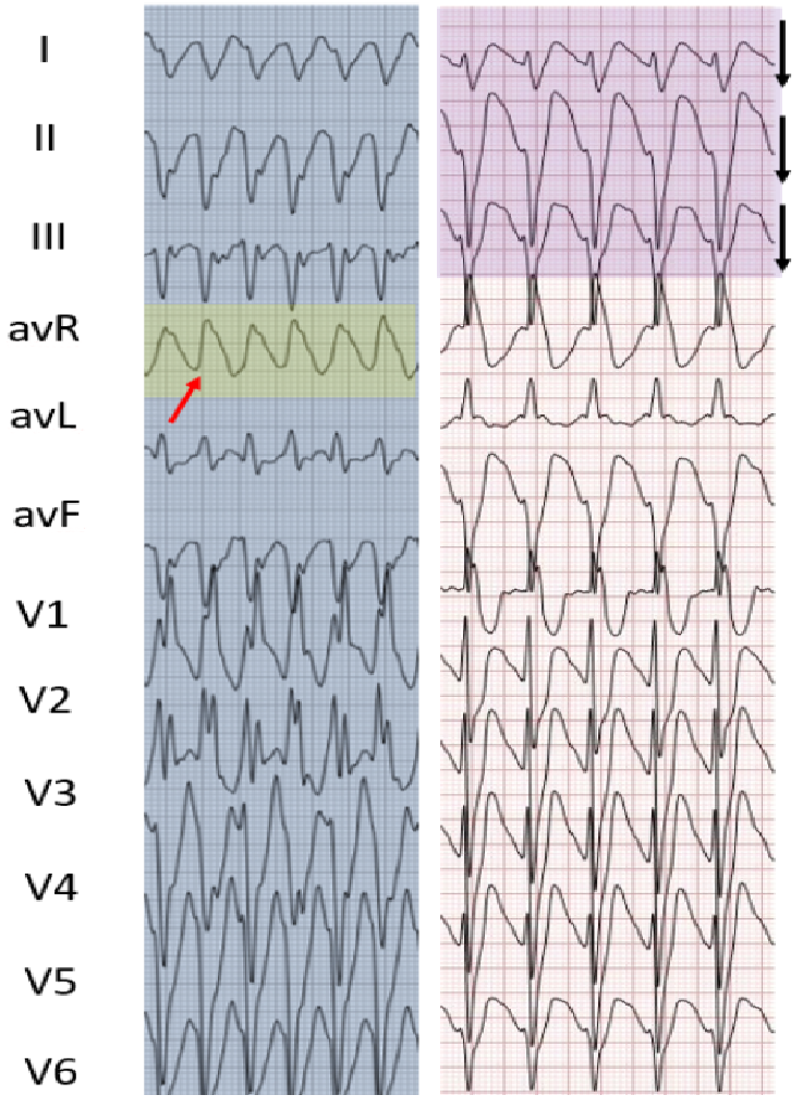 宽qrs波心动过速鉴别诊断的新方法仅用肢体导联就够了温故知心