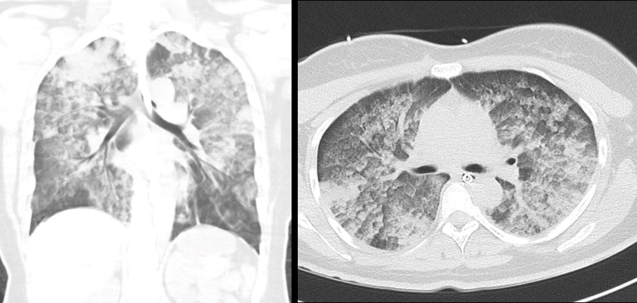 新冠肺炎肺部图片图片