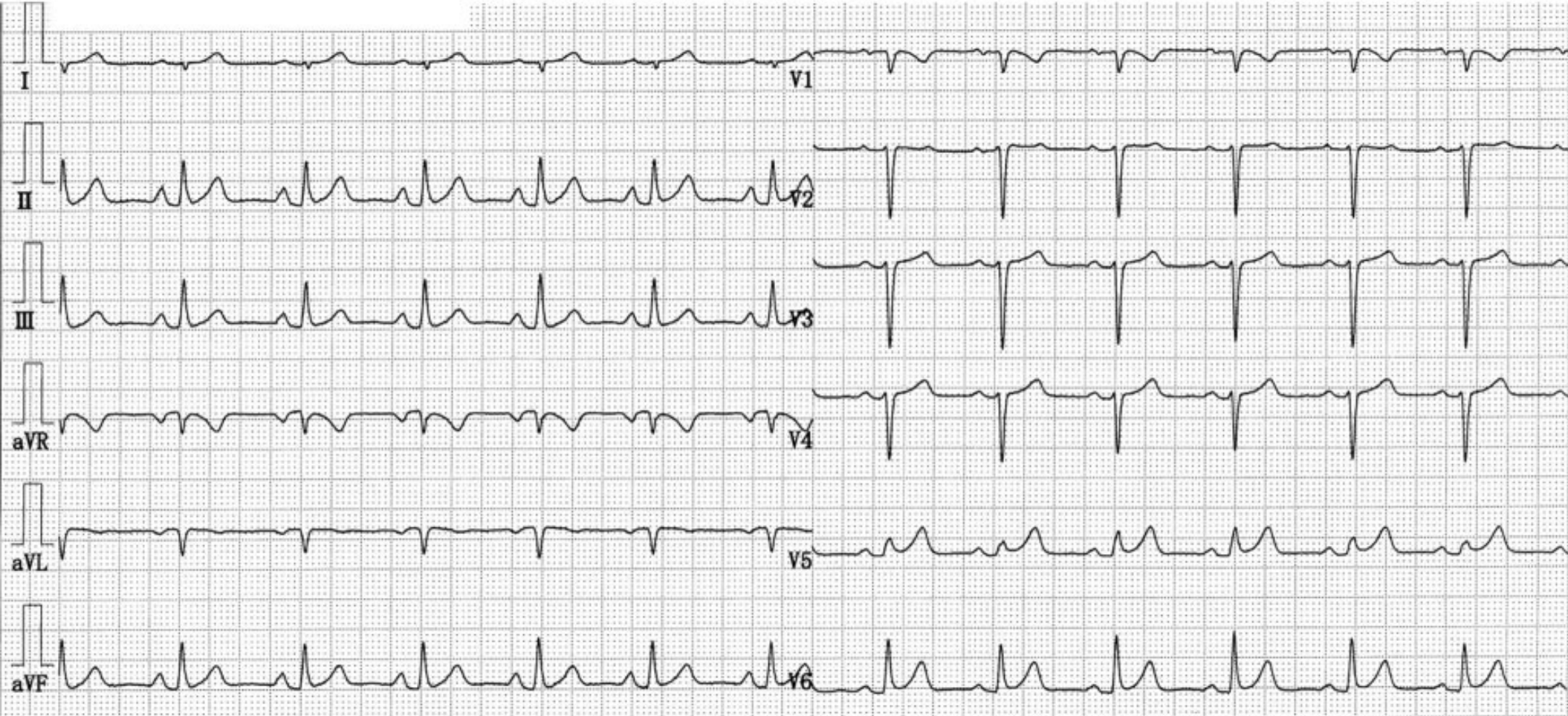 心电图出现st段抬高竟然是因为ta温故知心