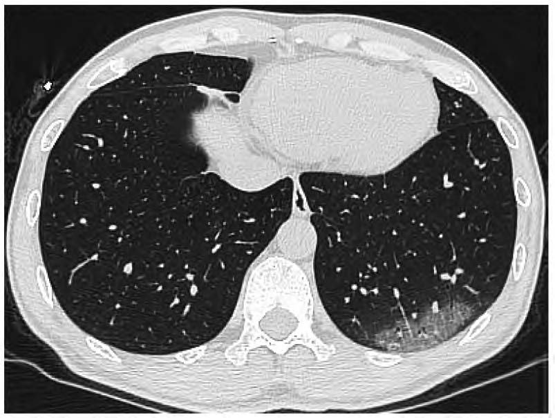 新冠肺部片子图片