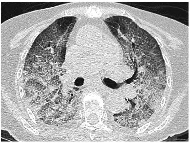 新冠肺炎肺部影像图片