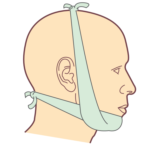 图137.4 "十"字绷带固定骨折的下颌骨