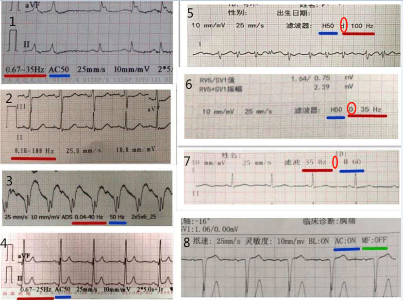 心电图记录纸上的小秘密|临床解惑
