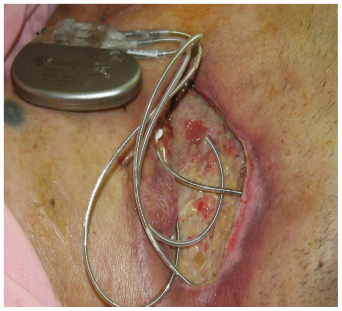 感染的起搏器和电极,电生理医生的噩梦