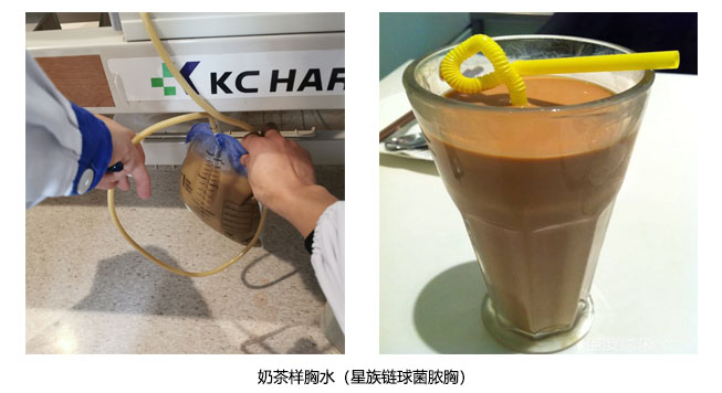 奇怪的奶茶样胸水不要漏诊这种细菌│临床心得