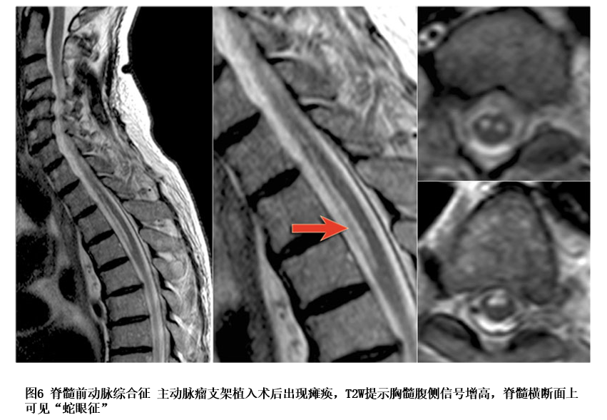 以中胸段或下胸段多见,脊髓核磁可发现以前角为中心的长t1