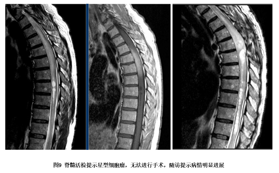 从1个病例出发,全面了解一些脊髓长节段病变的10大鉴别诊断