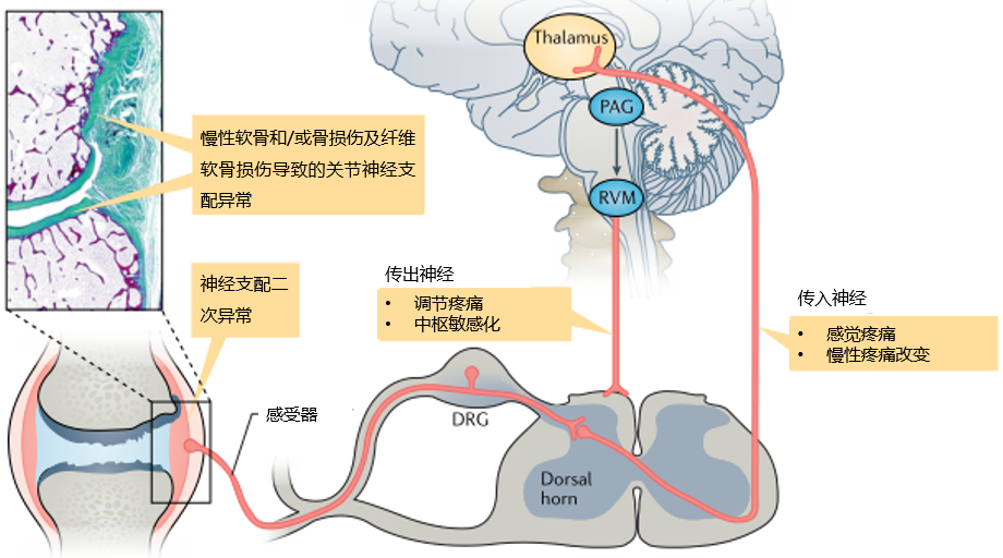 关键词: 难治性类风湿关节炎发病机制