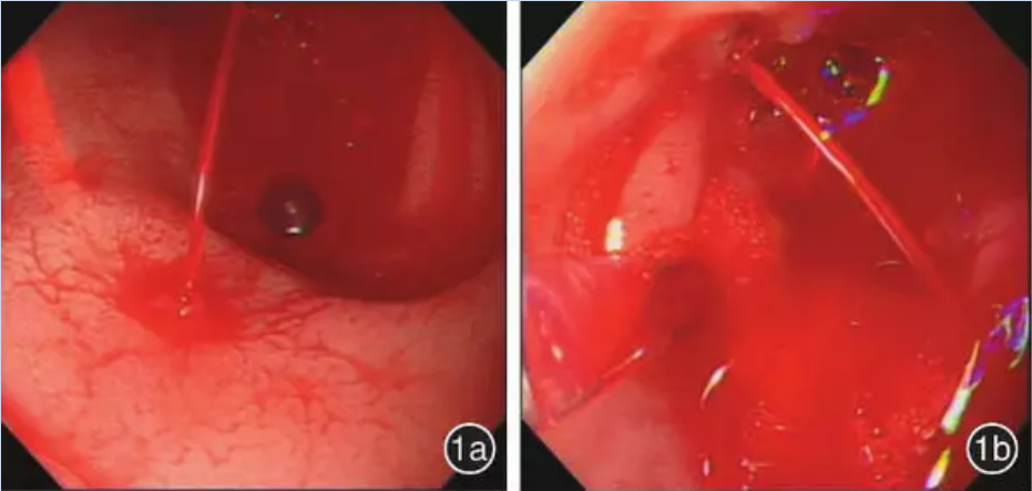 结合forrest分级,谈消化性溃疡出血的诊治 | 临床必备