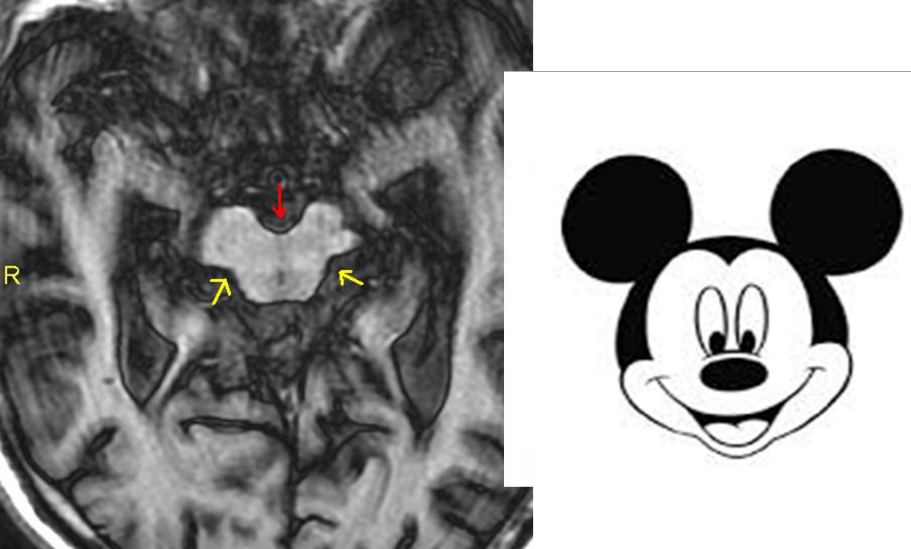 最后一个定性征象是"米老鼠征",也是在轴位上观察,可以看到因为中脑